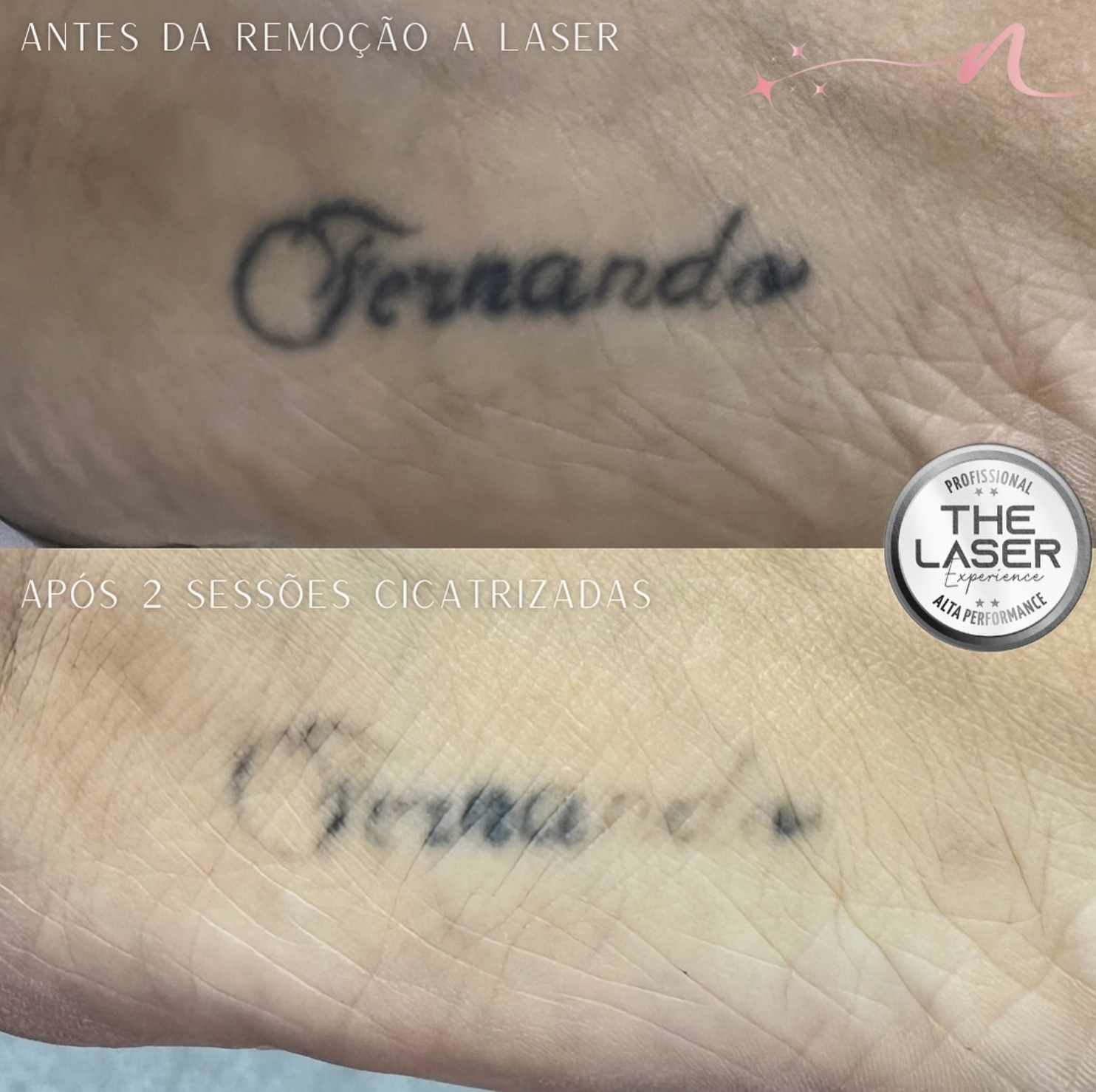 Resultado remoção tatuagem pulso